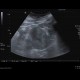 Renal carcinoma, Grawitz tumour: US - Ultrasound